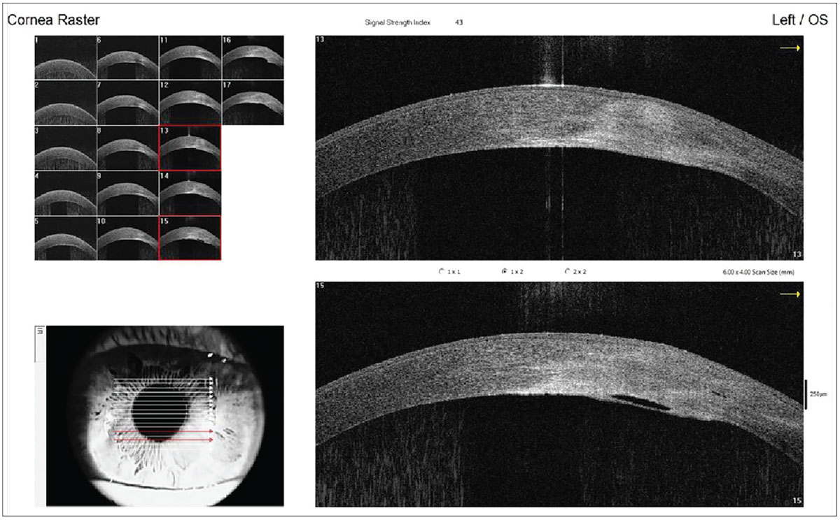 Fig. 2. This AS-OCT image highlights corneal edema and the break in Descemet’s membrane. If there was a dense surface opacity here, the break might have been missed. 