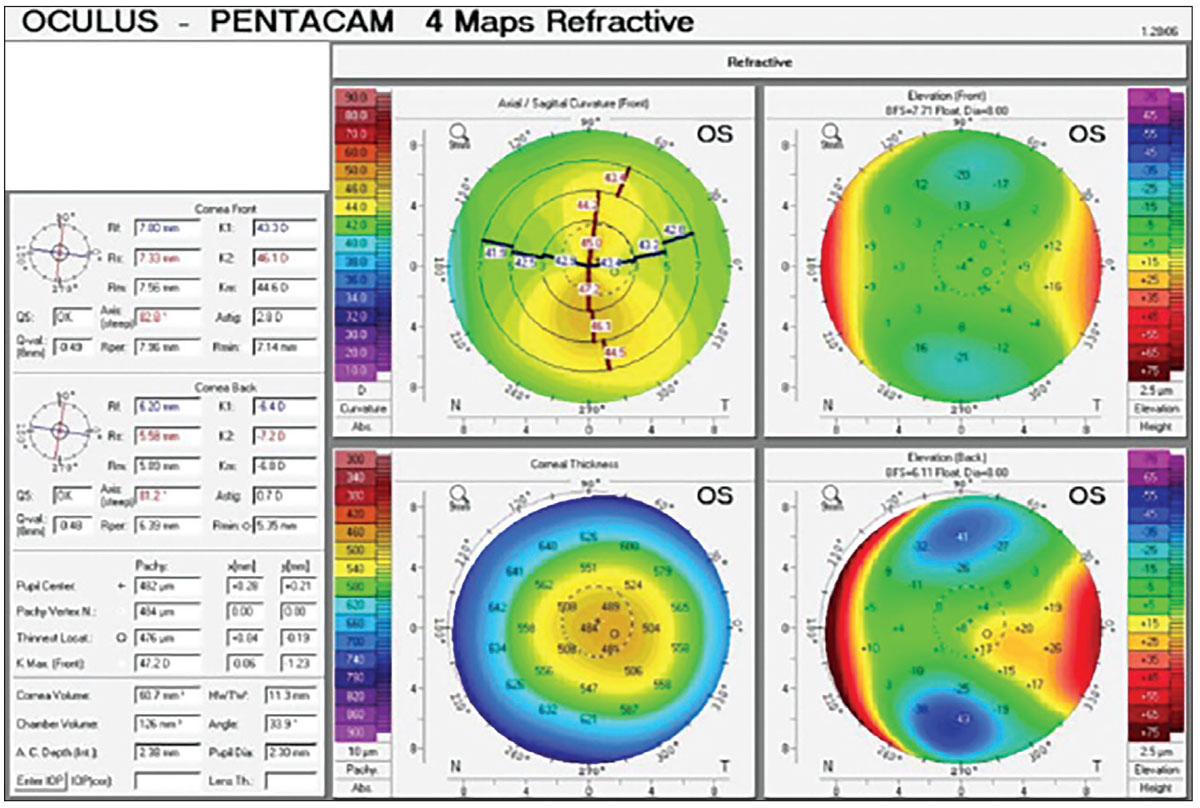 Fig. 3. Pentacam four maps refractive scan OS of a keratoconus suspect.