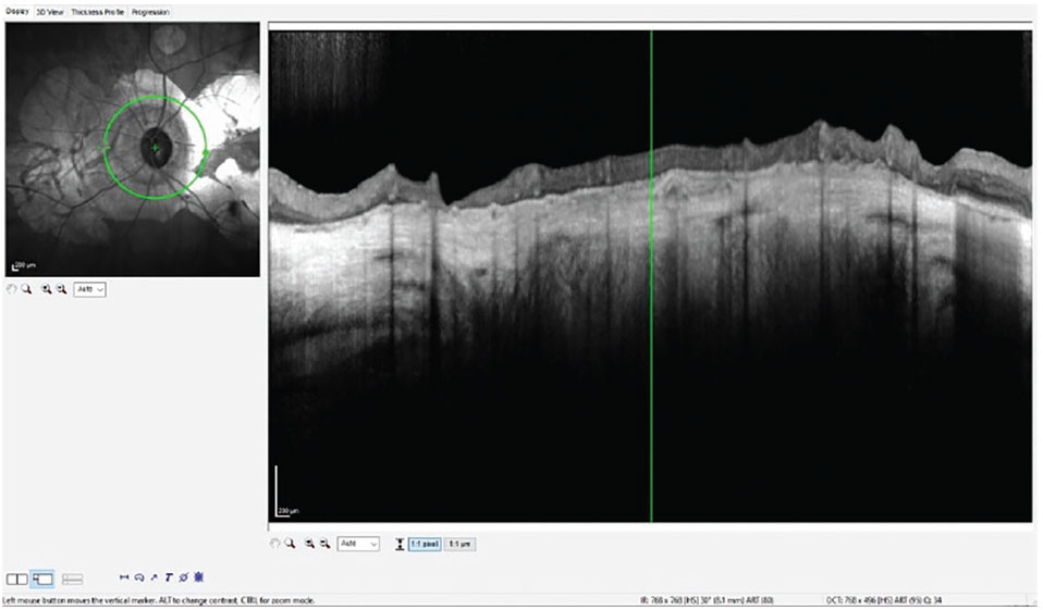 Fig. 1. Note the complete undermining of the RNFL measurements by the PPA, thereby complicating interpretation of this parameter related to glaucoma.