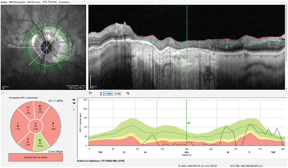 Fig. 2. The 3.5mm RNFL circle scan of the right optic nerve using the GMPE software. Note the relatively unencumbered 4.1mm and 4.7mm diameter circle scans.