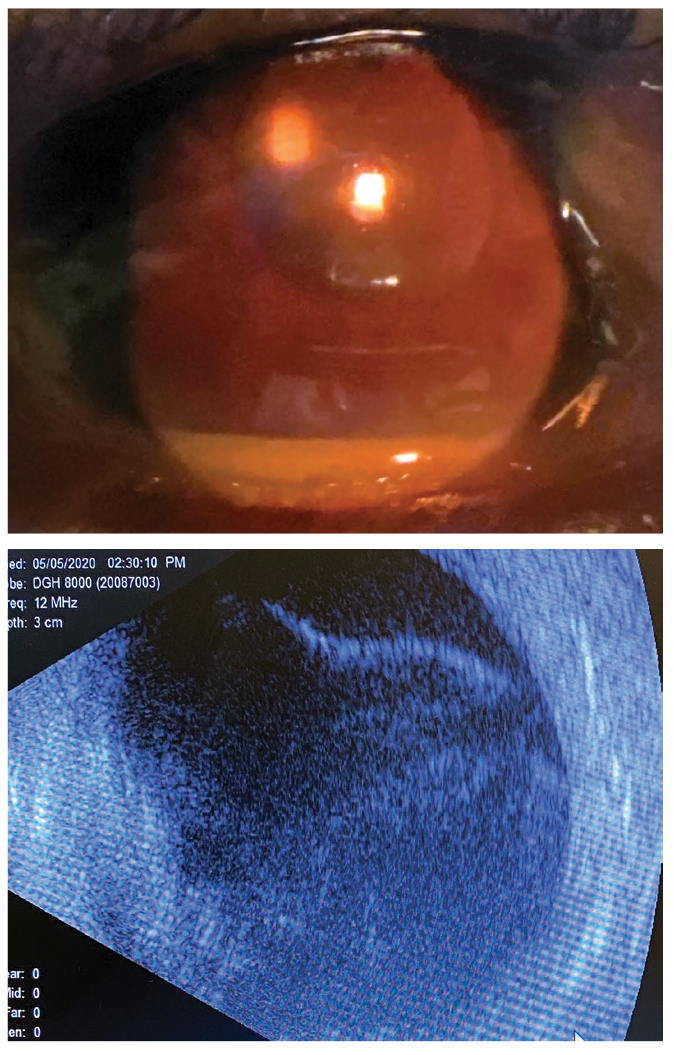 Slit lamp photo and ultrasound of our patient. Would you expect to see these presentations together?