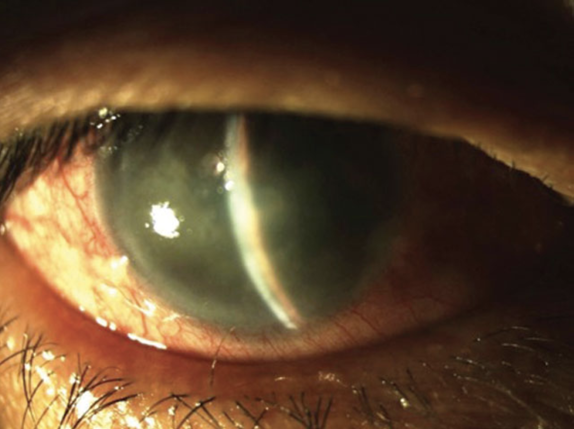 New research helps to chart the connections between genetic status and one’s propensity to develop angle-closure glaucoma in hopes of developing clinical applications to aid screening of suspects and better recognize disease progression.