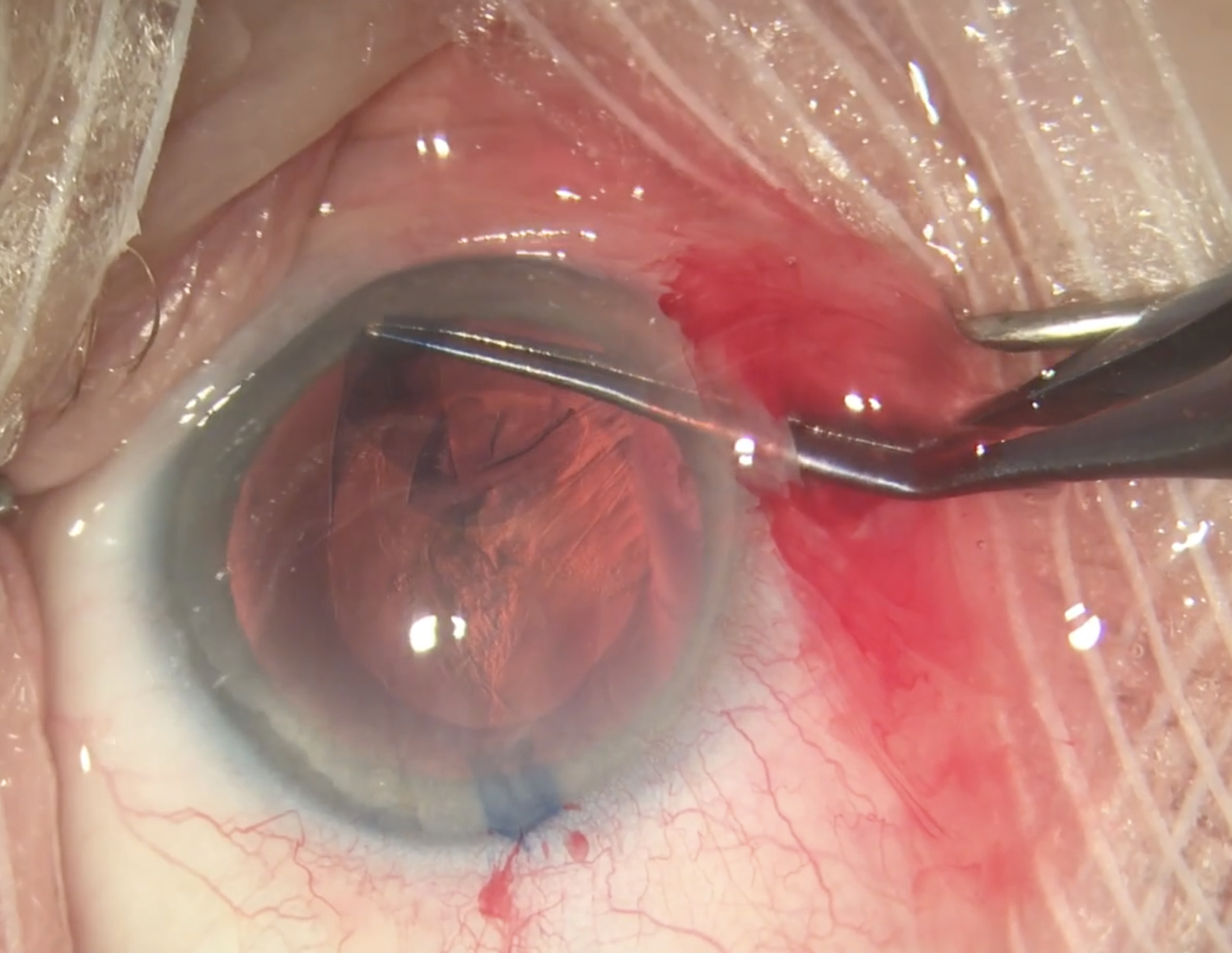 Today’s highly predictable and safe cataract procedures are laying the groundwork for an eventual shift to same-day bilateral surgery.
