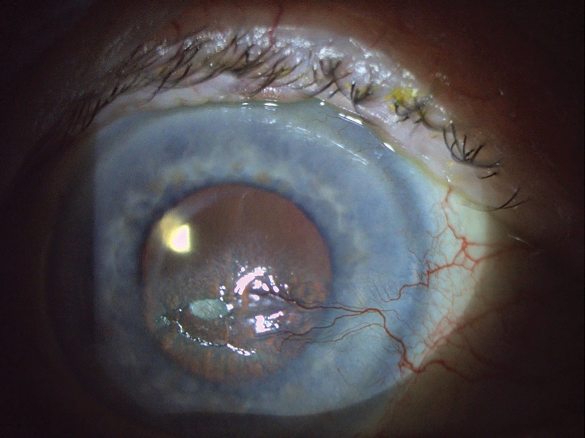 Corneal wounds may be helped in the future by topical insulin eyedrops if further research supports this intervention.
