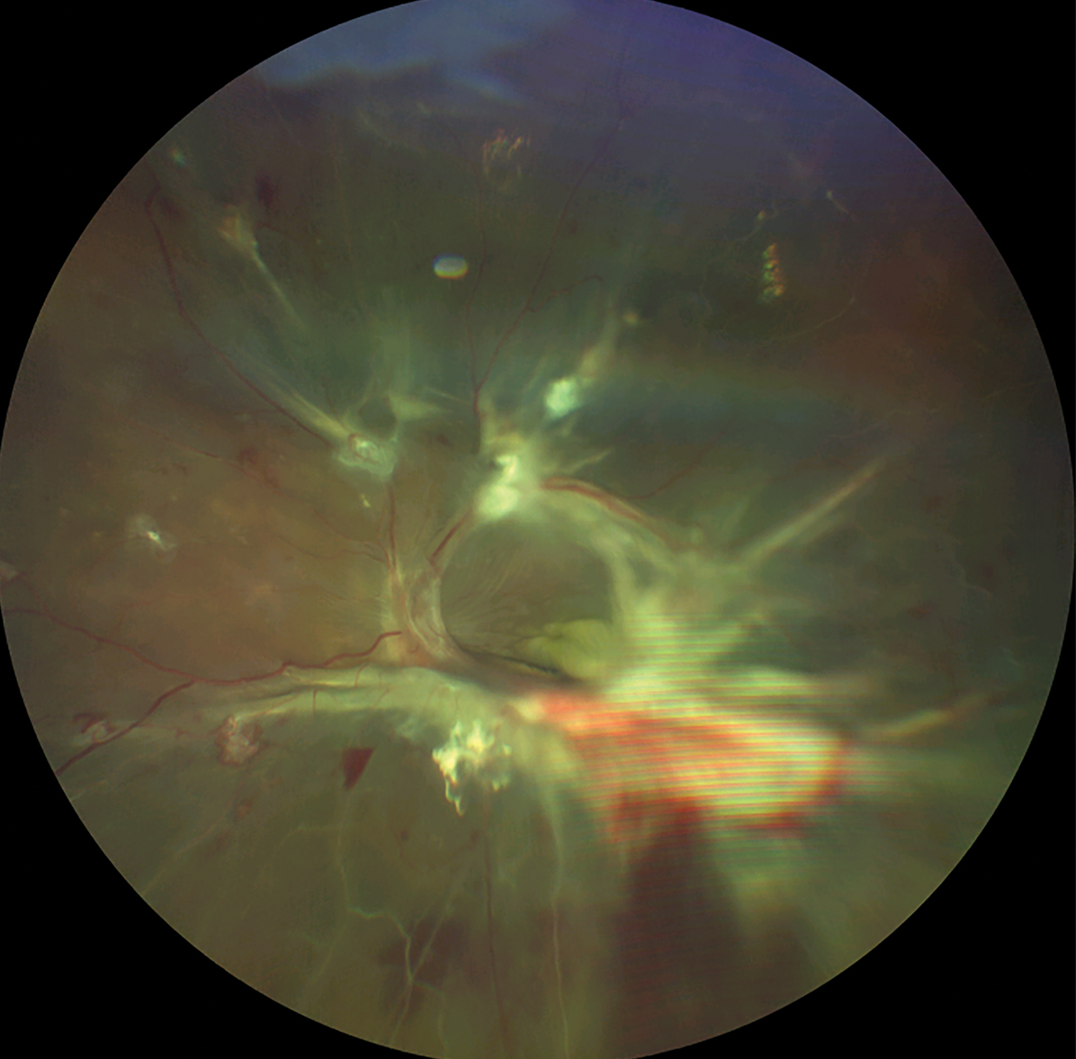 This fundus photo shows white fibrous tissue membranes accompanying neovascularization in proliferative DR.