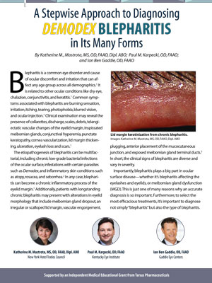 A Stepwise Approach to Diagnosing Demodex Blepharitis in Its Many Forms