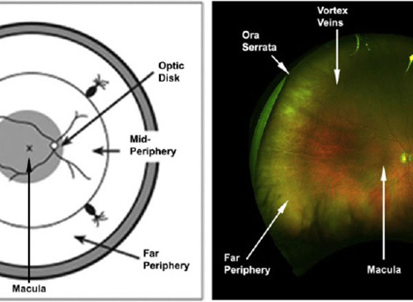 Peripheral Retinal Imaging and Disease Assessment