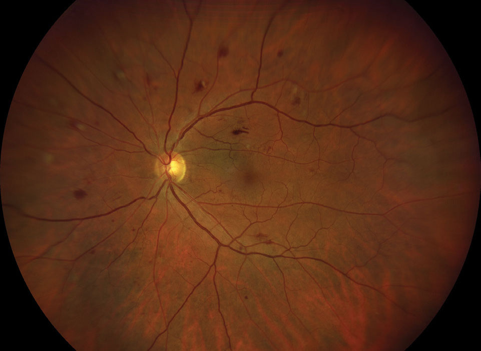 Staging of Diabetes and Diabetic Retinopathy