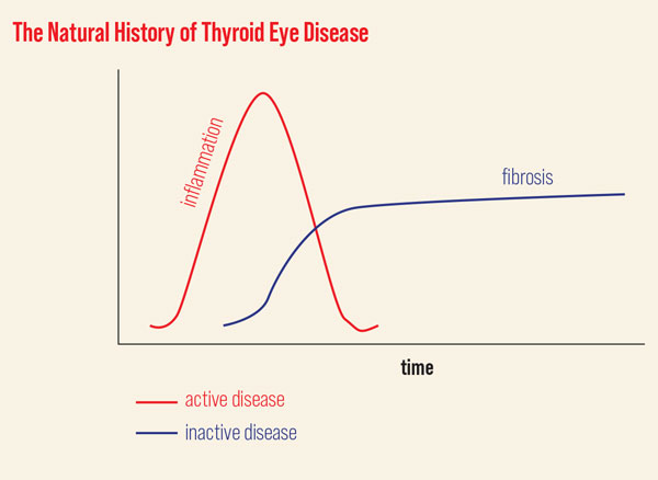 What ODs Need to Know About Thyroid Eye Disease