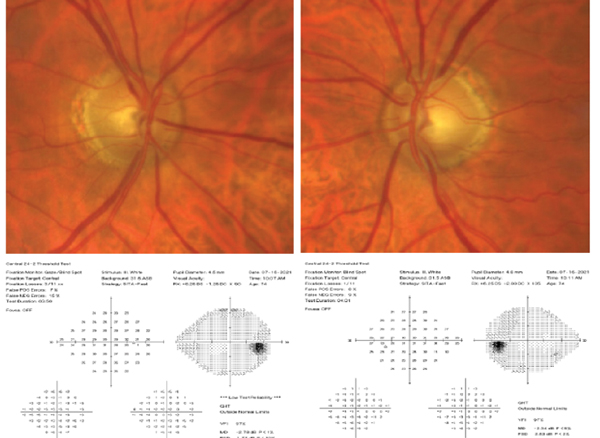 Should You Prescribe a Glaucoma Drug for Ocular Hypertension?