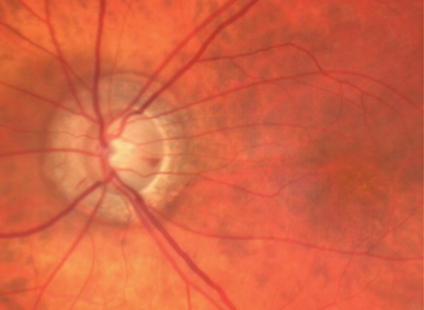 Optic Nerve Disorders: How They Manifest and What They Mean