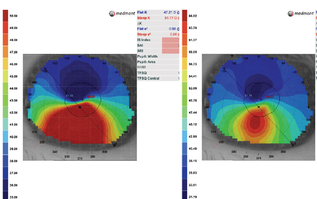 The Definitive Guide to Corneal Topography