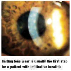 Keratitis steroid eye drops