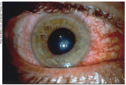 Systemic steroid induced glaucoma