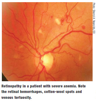 Lesson: When the Retina Reveals a Blood Disorder