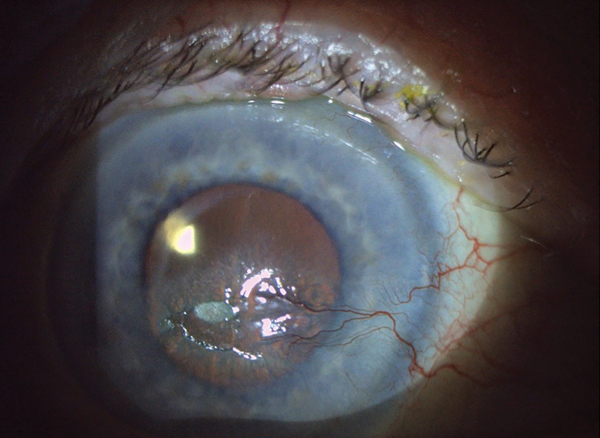 Corneal Pain Presentations: Causes and Interventions